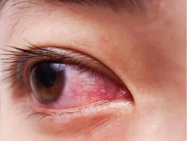 眼部出血造成的原因有哪些？.jpg
