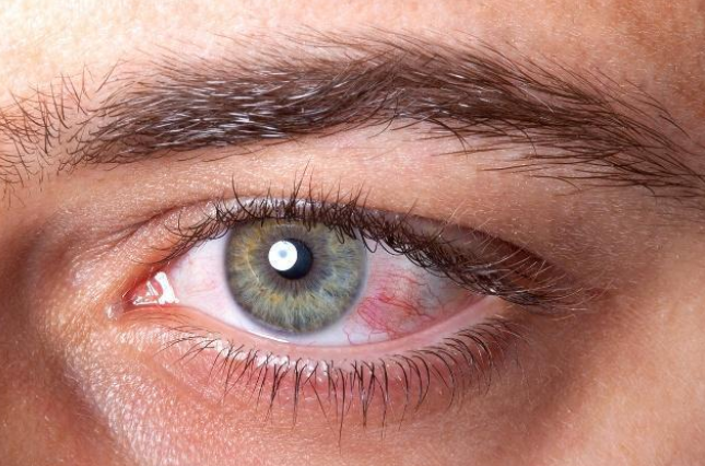 眼睛里出现红血丝的原因是什么.png