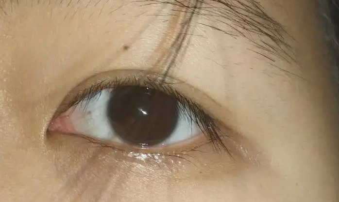 棕色的眼球正常么？